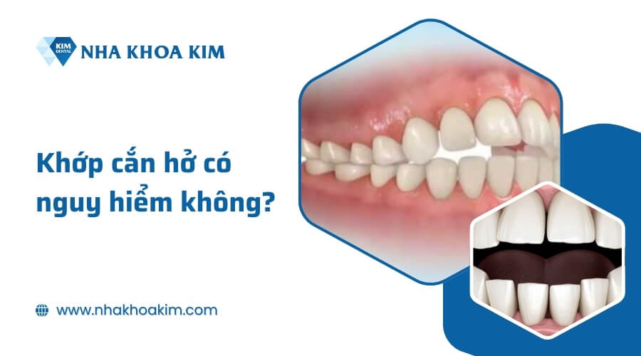 Khớp cắn hở có nguy hiểm không?