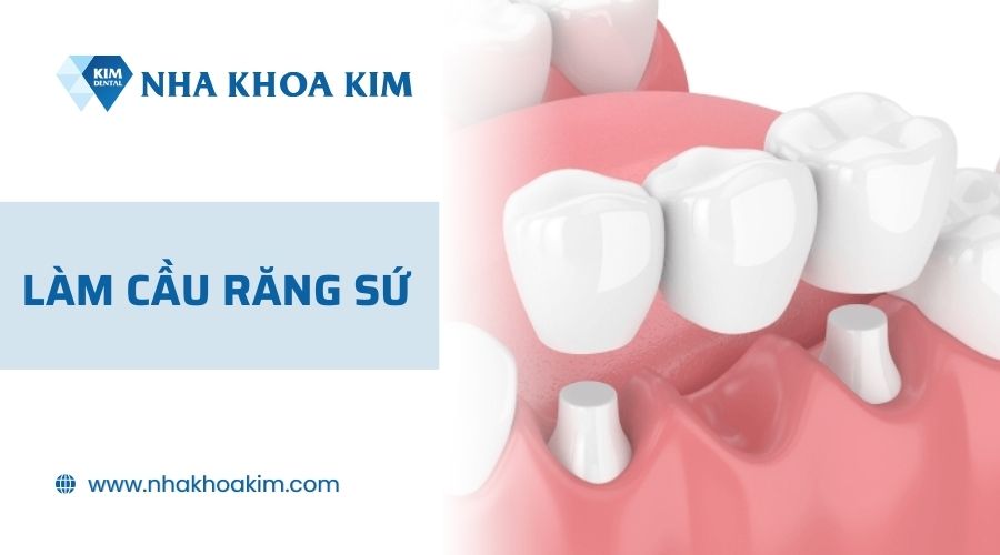 Phương pháp phục hình răng mất bằng cầu răng sứ