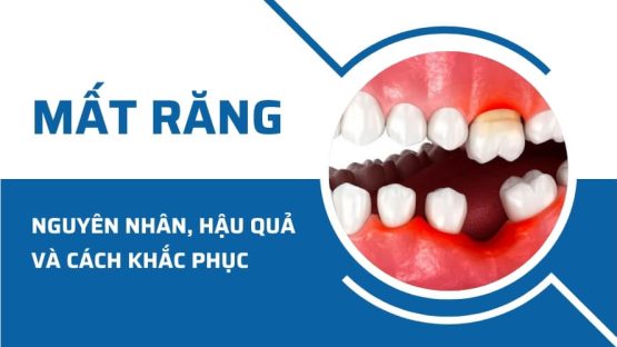 Mất răng: Nguyên nhân, hậu quả và cách khắc phục