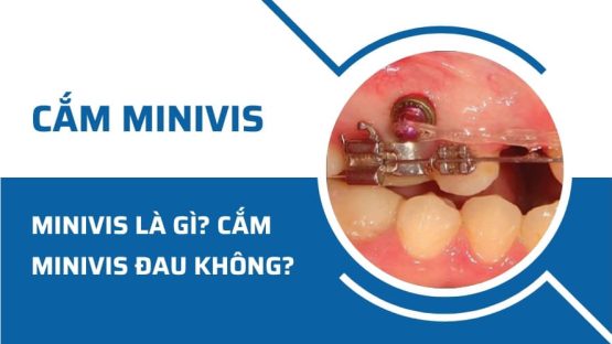 Minivis niềng răng là gì? Cắm minivis có đau không?