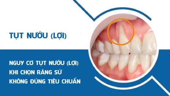 Nguy cơ tụt nướu (lợi) khi chọn răng sứ không đúng tiêu chuẩn