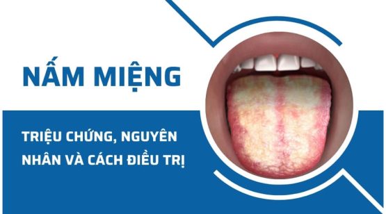 Nấm miệng: Triệu chứng, nguyên nhân và cách điều trị