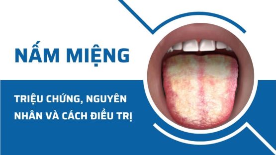 Nấm miệng: Triệu chứng, nguyên nhân và cách điều trị