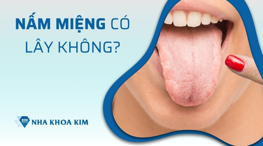 Nấm miệng có lây không?