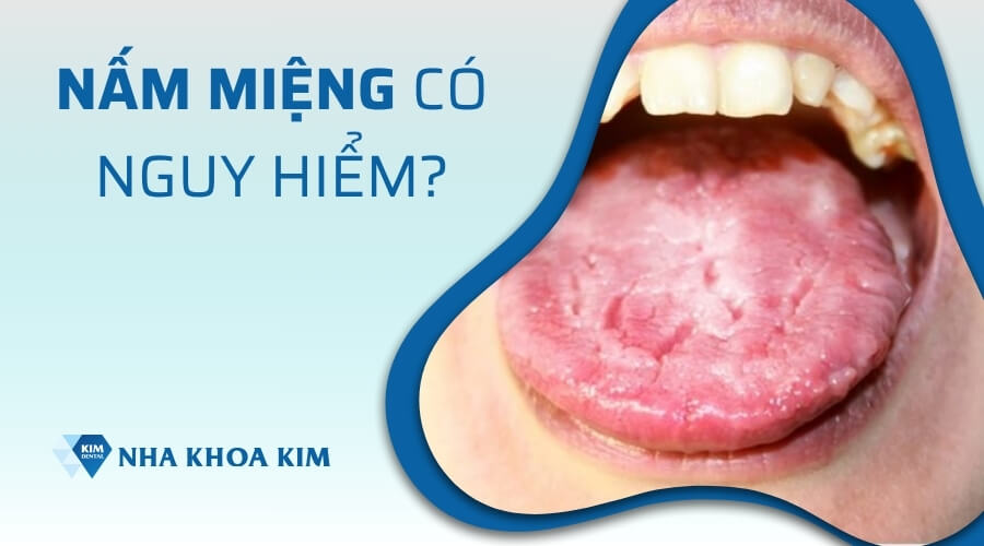Nấm miệng có nguy hiểm không?