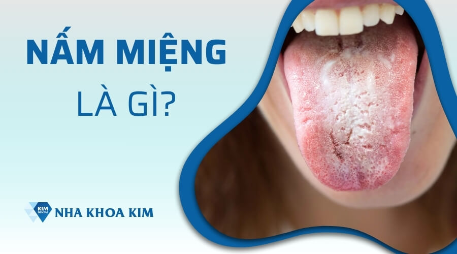 Nấm miệng là gì?