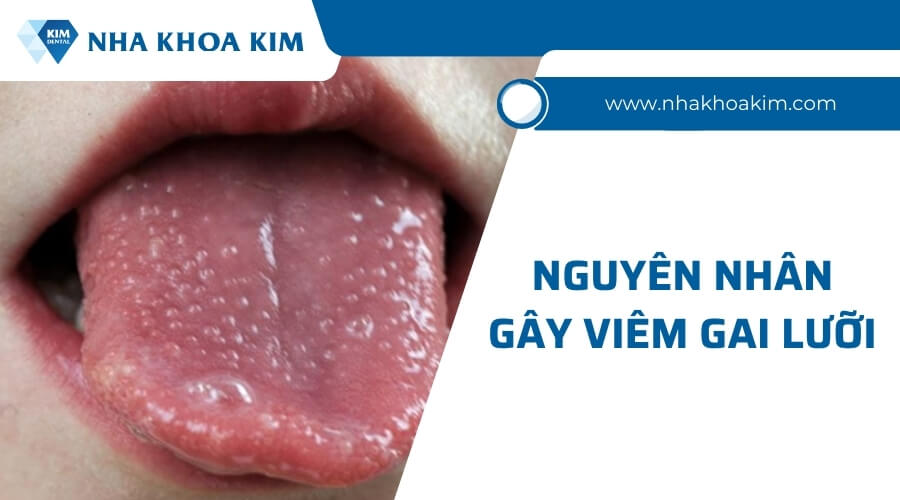 Nguyên nhân gây viêm gai lưỡi là gì?