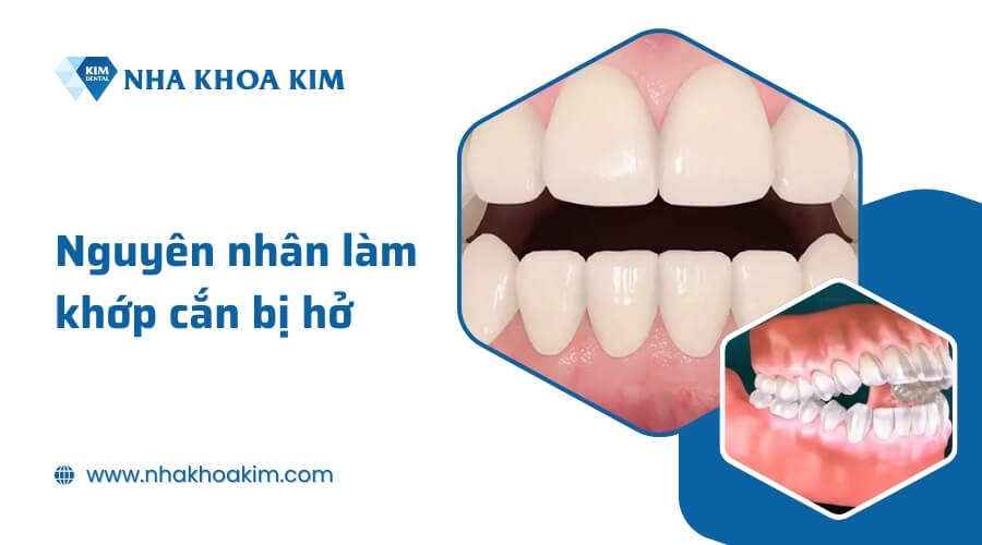 Nguyên nhân làm khớp cắn bị hở