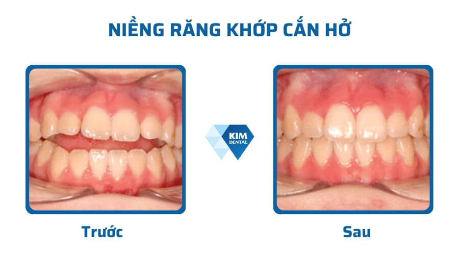 Niềng răng khớp cắn hở