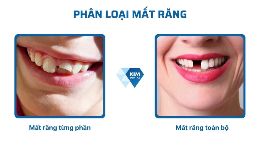 Phân loại mất răng