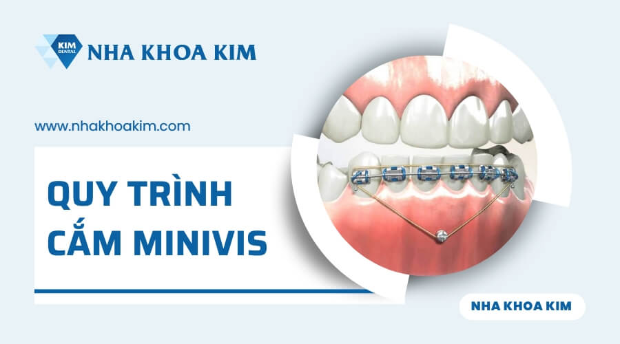 Quy trình cắm minivis niềng răng