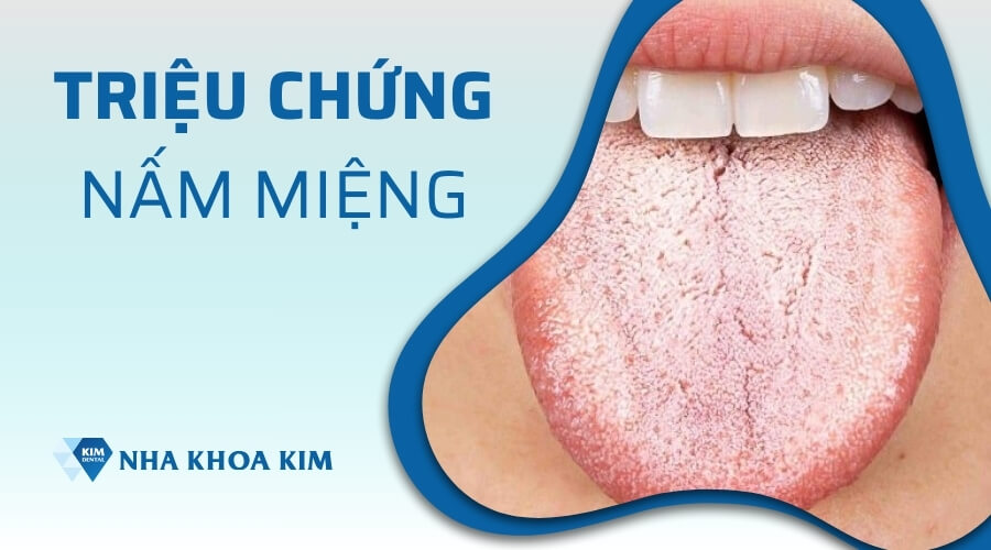 Triệu chứng của nấm miệng