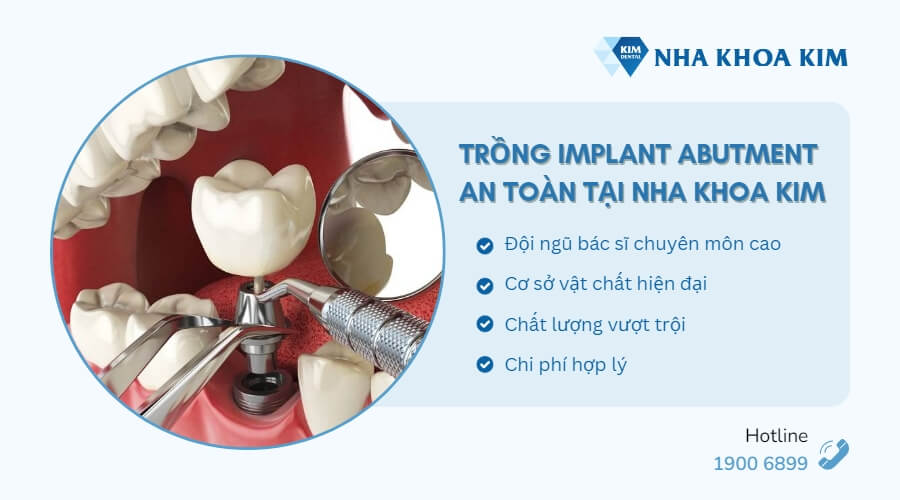 Địa chỉ mua và trồng implant abutment an toàn, uy tín hiện nay
