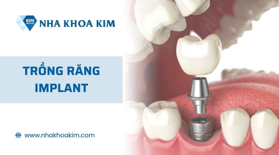 Phục hình răng mất bằng phương pháp trồng răng implant