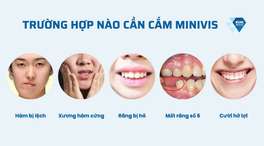 Trường hợp niềng răng nào cần cắm minivis