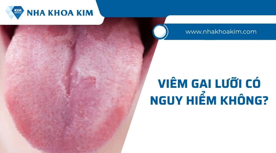 Viêm gai lưỡi có nguy hiểm không?