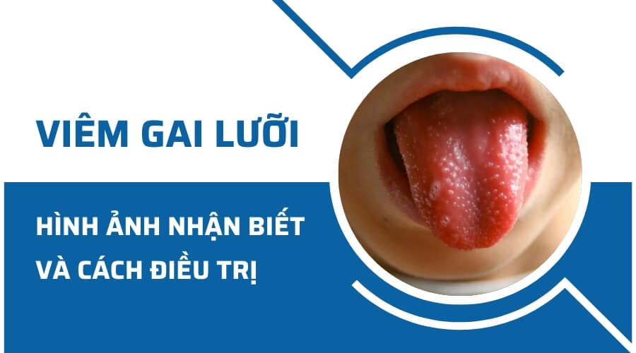 Nhận biết hình ảnh viêm gai lưỡi và cách điều trị