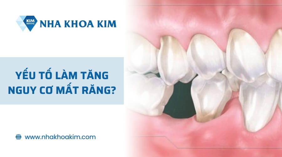 Yếu tố làm tăng nguy cơ mất răng?