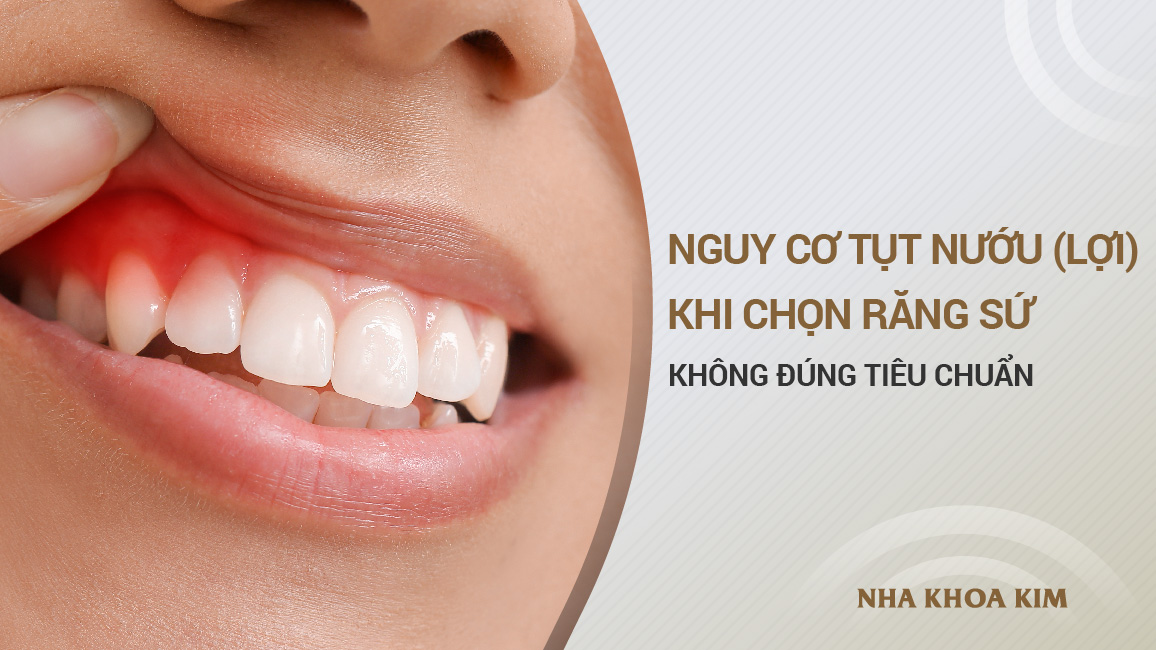 Nguy cơ tụt nướu (lợi) khi chọn răng sứ không đúng tiêu chuẩn
