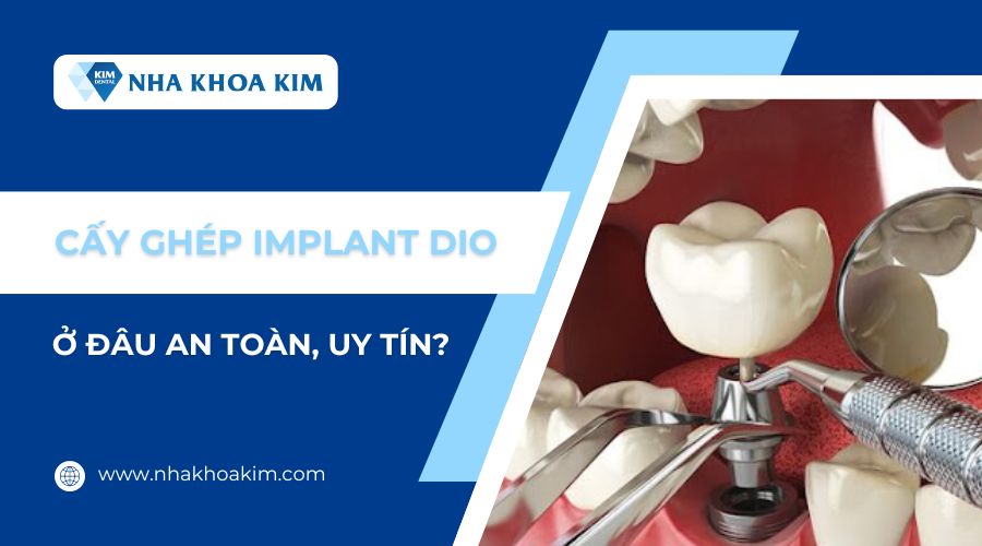 Cấy ghép trụ Implant Dio ở đâu an toàn, uy tín?