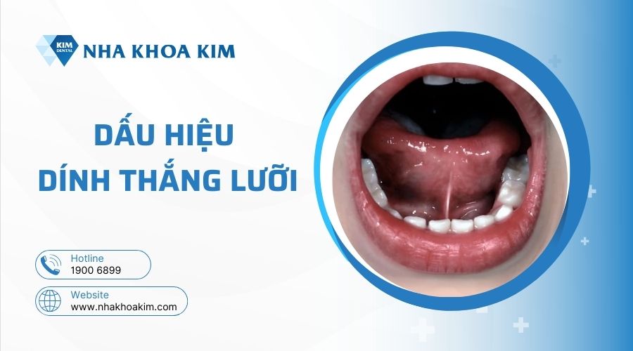 Dấu hiệu dính thắng lưỡi