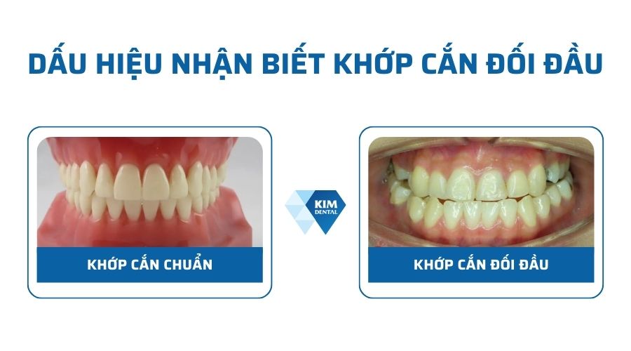 Dấu hiệu nhận biết khớp cắn đối đầu