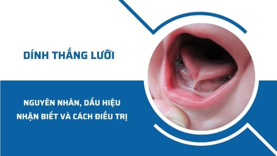 Dính thắng lưỡi: Nguyên nhân, nhận biết và cách điều trị