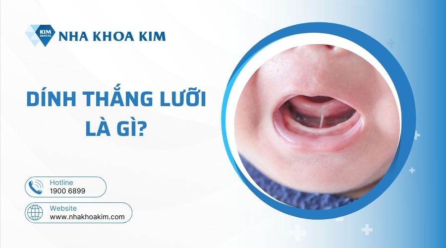 Dính thắng lưỡi là gì?