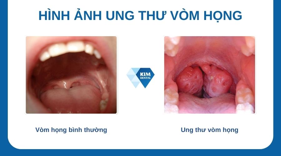 Hình ảnh ung thư vòm họng