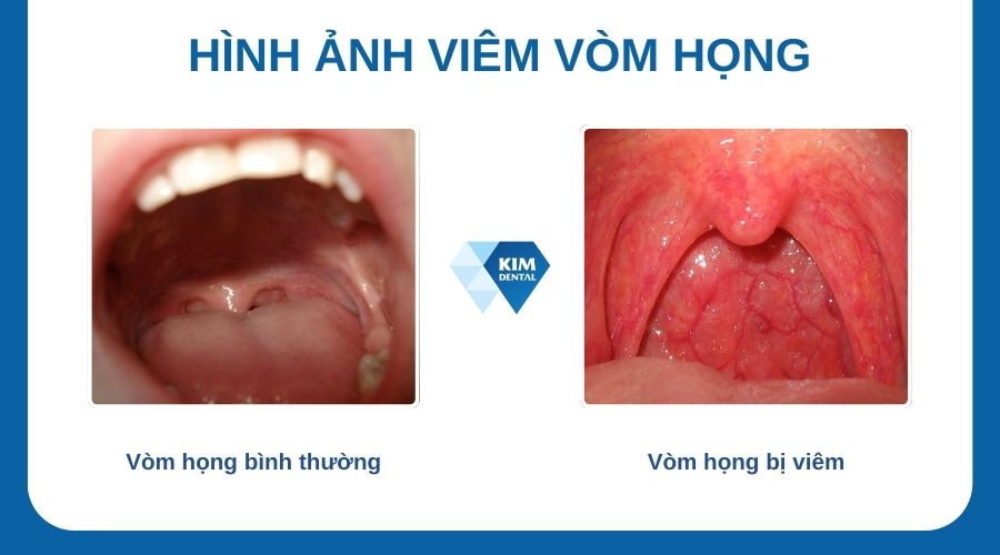 10. Câu Hỏi Thường Gặp Về Viêm Họng