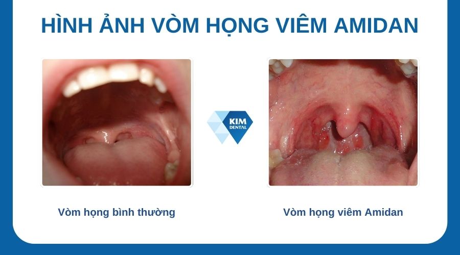 Viêm amidan