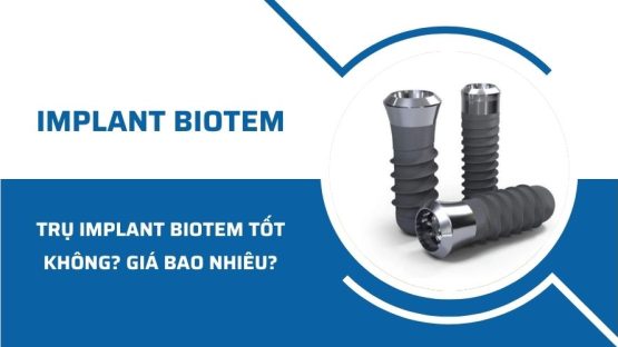 Trụ Implant Biotem có tốt không? Giá bao nhiêu?