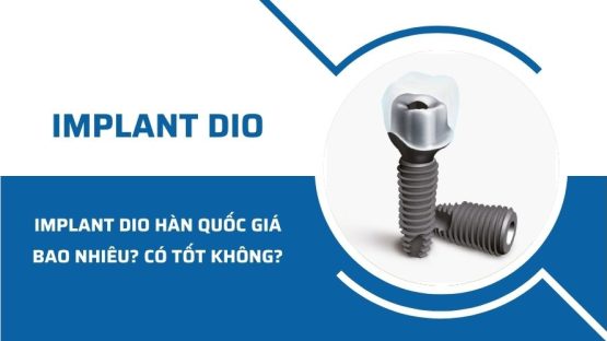 Trụ Implant Dio Hàn Quốc giá bao nhiêu? Có tốt không?