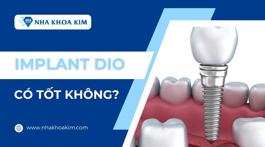 Tụ Implant Dio có tốt không?