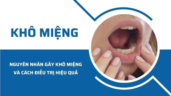 Nguyên nhân gây khô miệng và cách điều trị hiệu quả