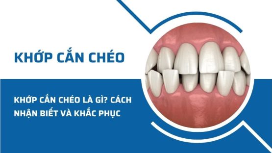 Khớp cắn chéo là gì? Cách nhận biết và khắc phục