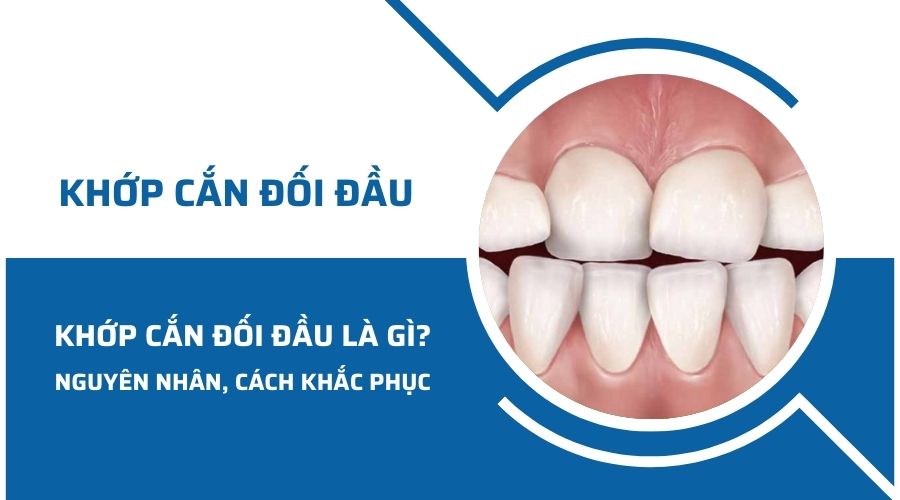 Khớp cắn đối đầu là gì? Nguyên nhân và cách khắc phục