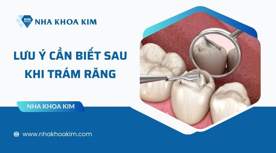 Những lưu ý cần biết sau khi trám răng