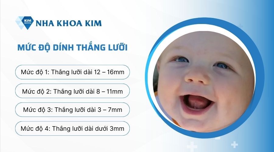 Nhận biết các mức độ dính thắng lưỡi