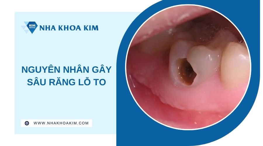 Nguyên nhân dẫn đến sâu răng lỗ to