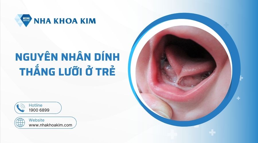 Nguyên nhân dính thắng lưỡi ở trẻ