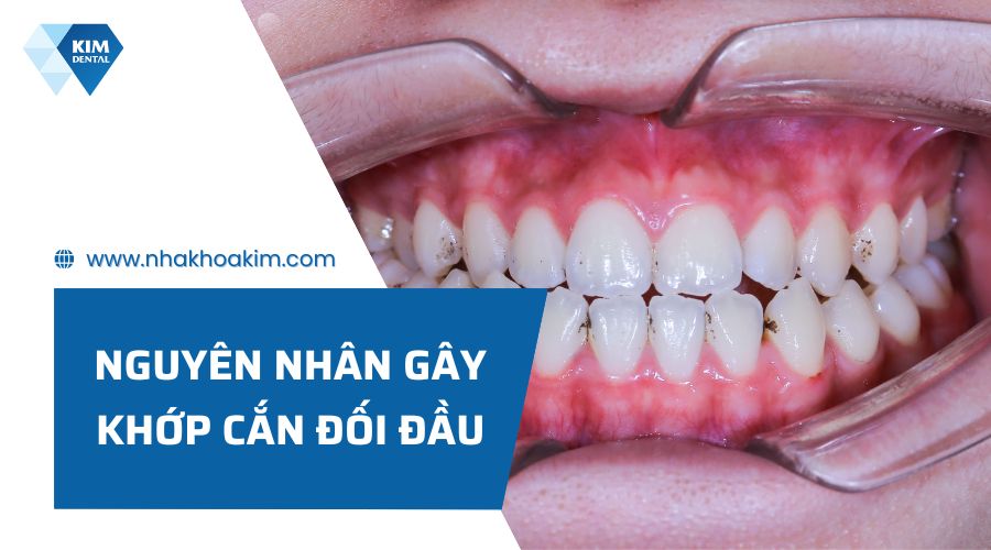 Nguyên nhân gây khớp cắn đối đầu