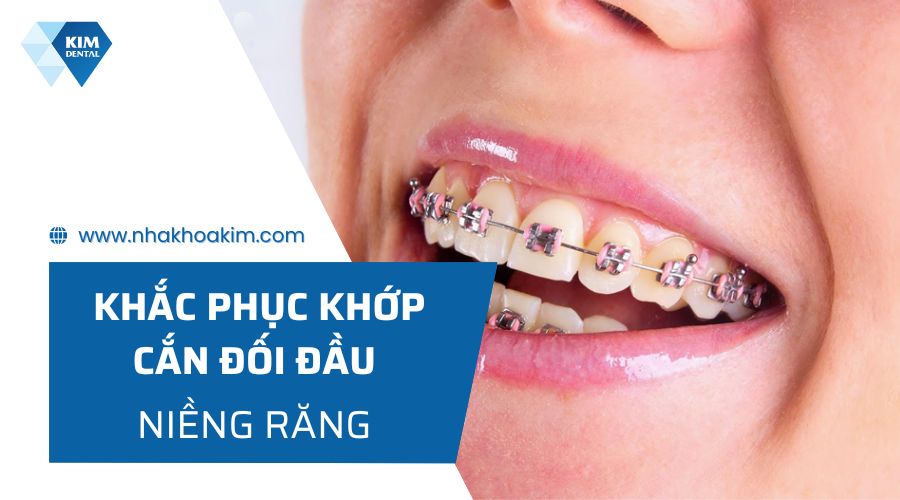 Niềng răng khắc phục khớp cắn đối đầu
