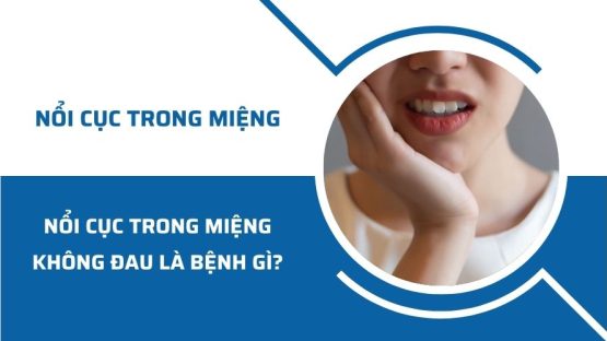 Nổi cục mụn thịt trong miệng không đau là bệnh gì?