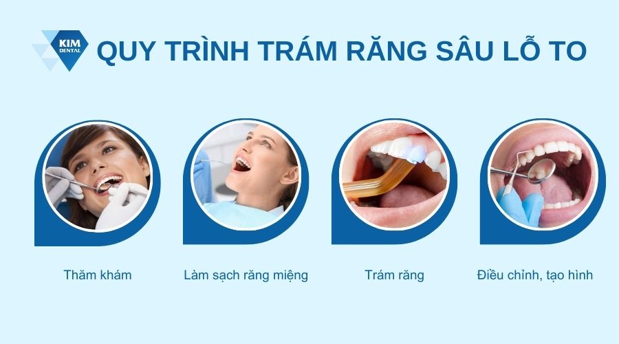 Quy trình trám răng sâu lỗ to