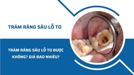 Trám răng sâu lỗ to có được không? Giá bao nhiêu?