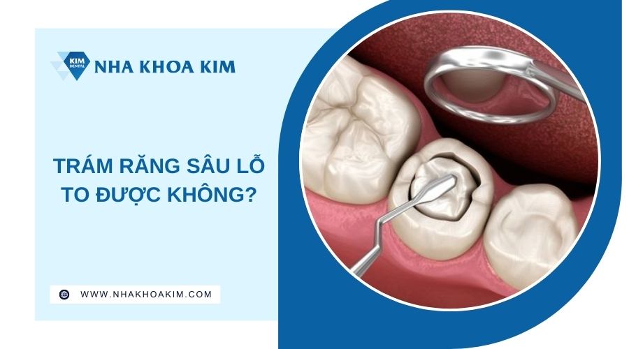 Trám răng sâu lỗ to được không?