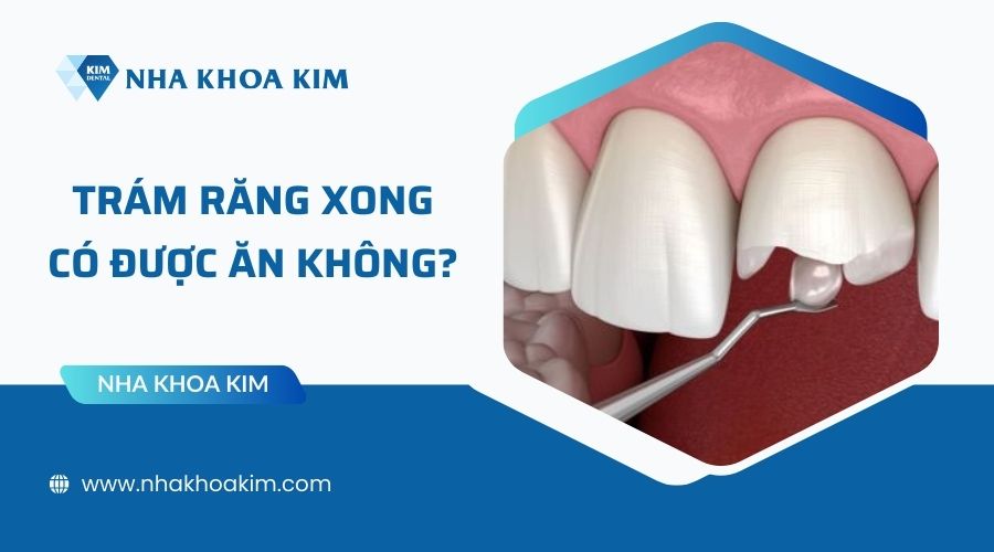 Trám răng xong có được ăn không?