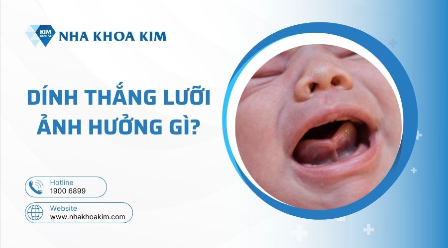 Dính thắng lưỡi có ảnh hưởng gì?