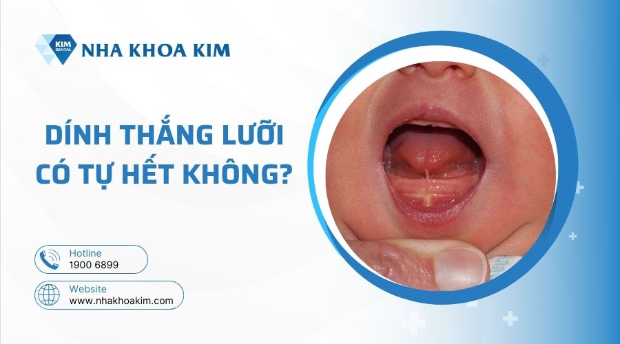 Trẻ bị dính thắng lưỡi có tự hết không?